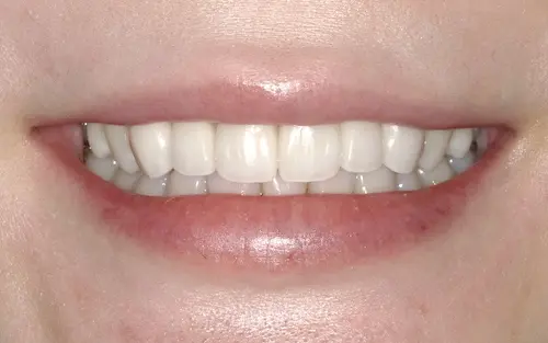 セラミック矯正｜東京港区青山一丁目の歯医者