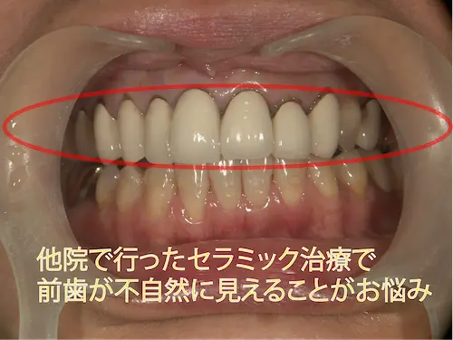 黒くなった差し歯ビフォー