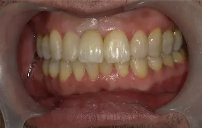 痛くないインプラントの症例 アフター | 東京・港区・青山