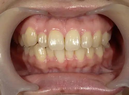 部分矯正 ビフォー｜東京・港区の歯医者