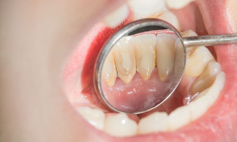 東京都港区青山の歯医者 歯周病とはどんな病気か