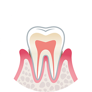 東京都港区青山の歯医者 歯肉炎